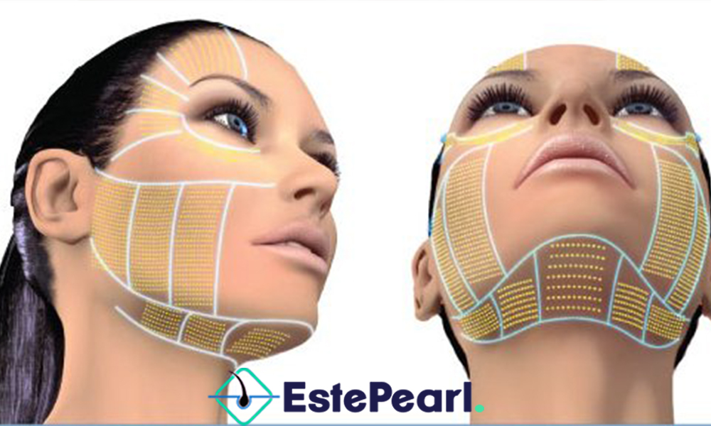 Ultherapy Nonsurgical Facelift Este Pearl