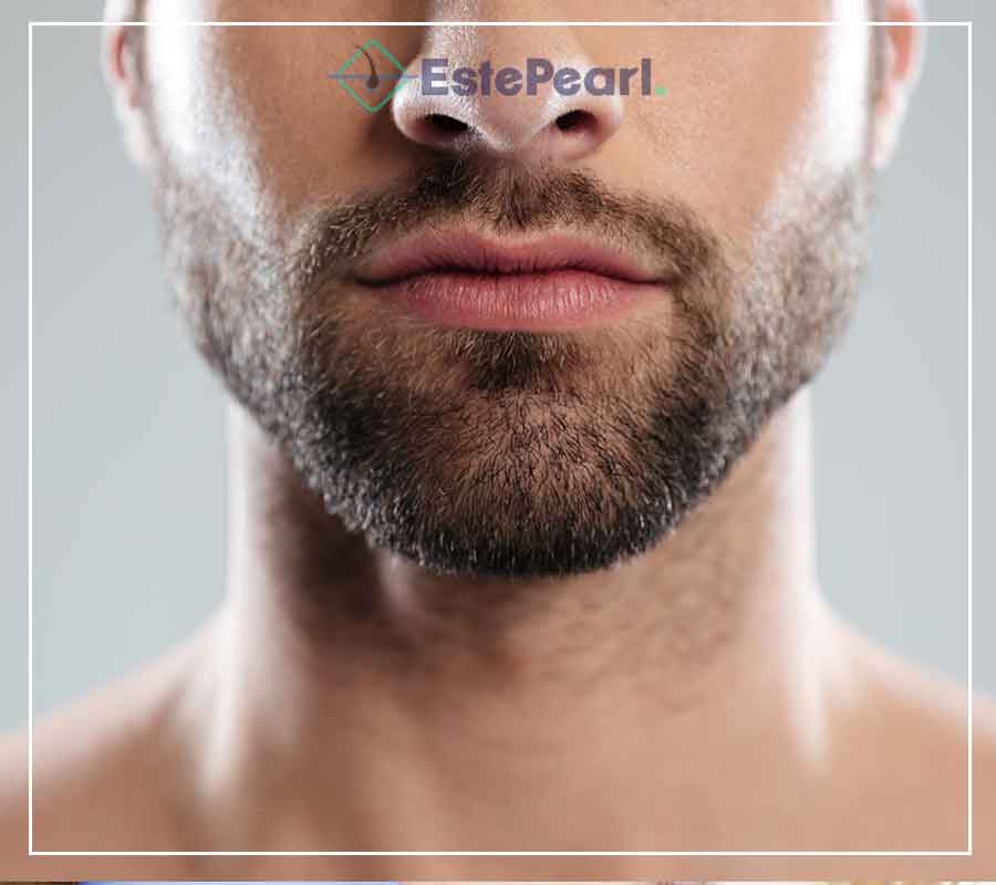 Beard Transplant