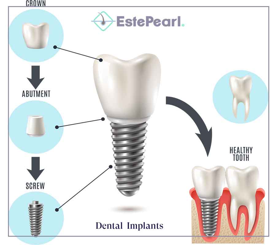 Dental Implants