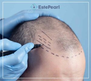 FUE Hair Transplant