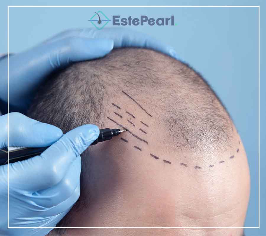 FUE Hair Transplant