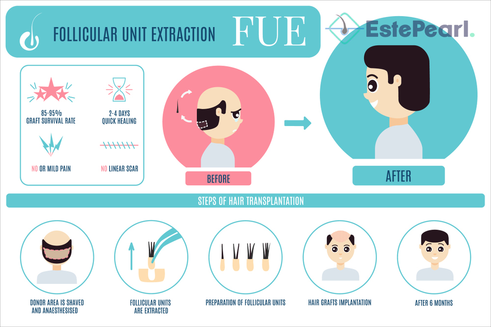 FUE-hair-transplant