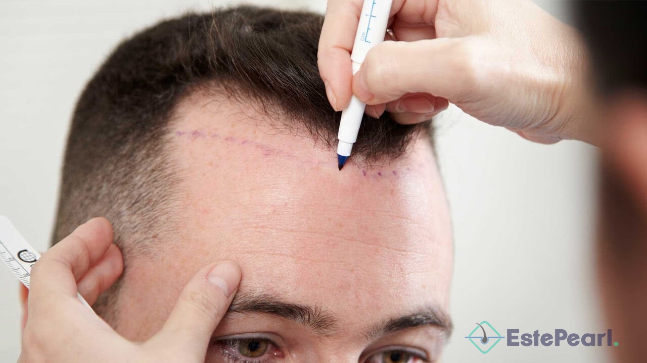 Hair Transplant Process