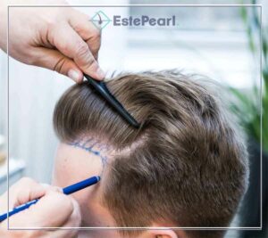 SAPPHIRE FUE HAIR TRANSPLANT