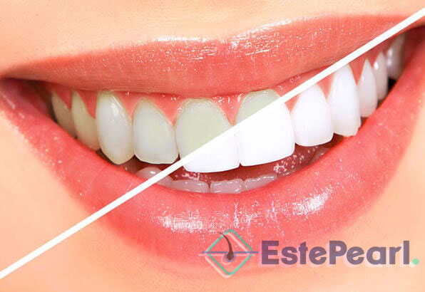 Teeth Whitening