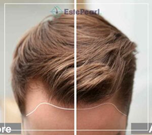 Unshaven Hair Transplant