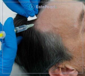 Hair Transplant Procedure Steps
