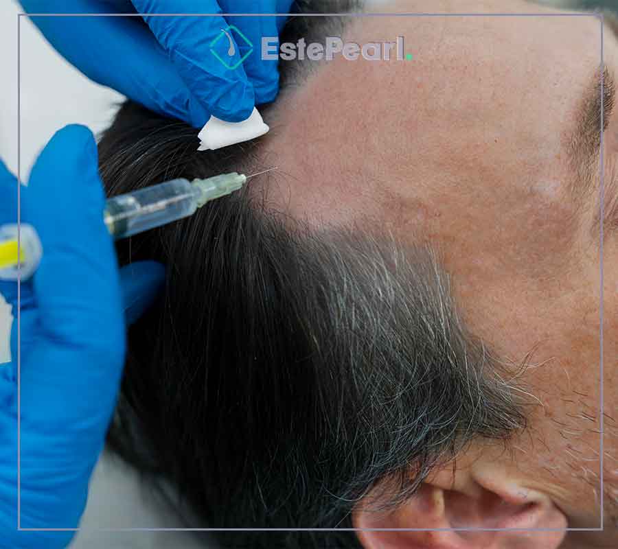 Hair Transplant Procedure Steps
