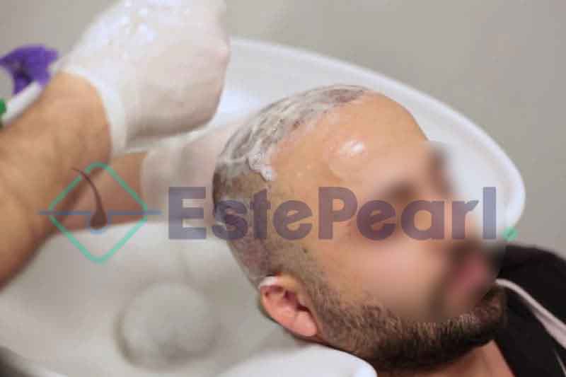 How-To-Wash-Hair-After-A-FUE-Hair-Transplant