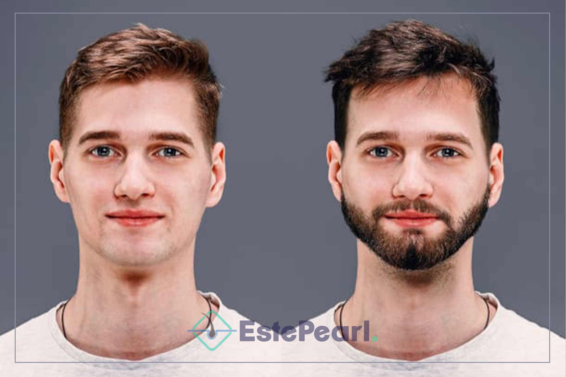 Who Can Have Beard Transplant Treatment