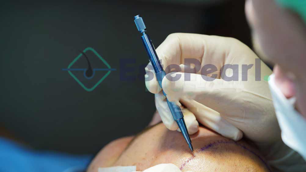 sapphire-fue-hair-transplant