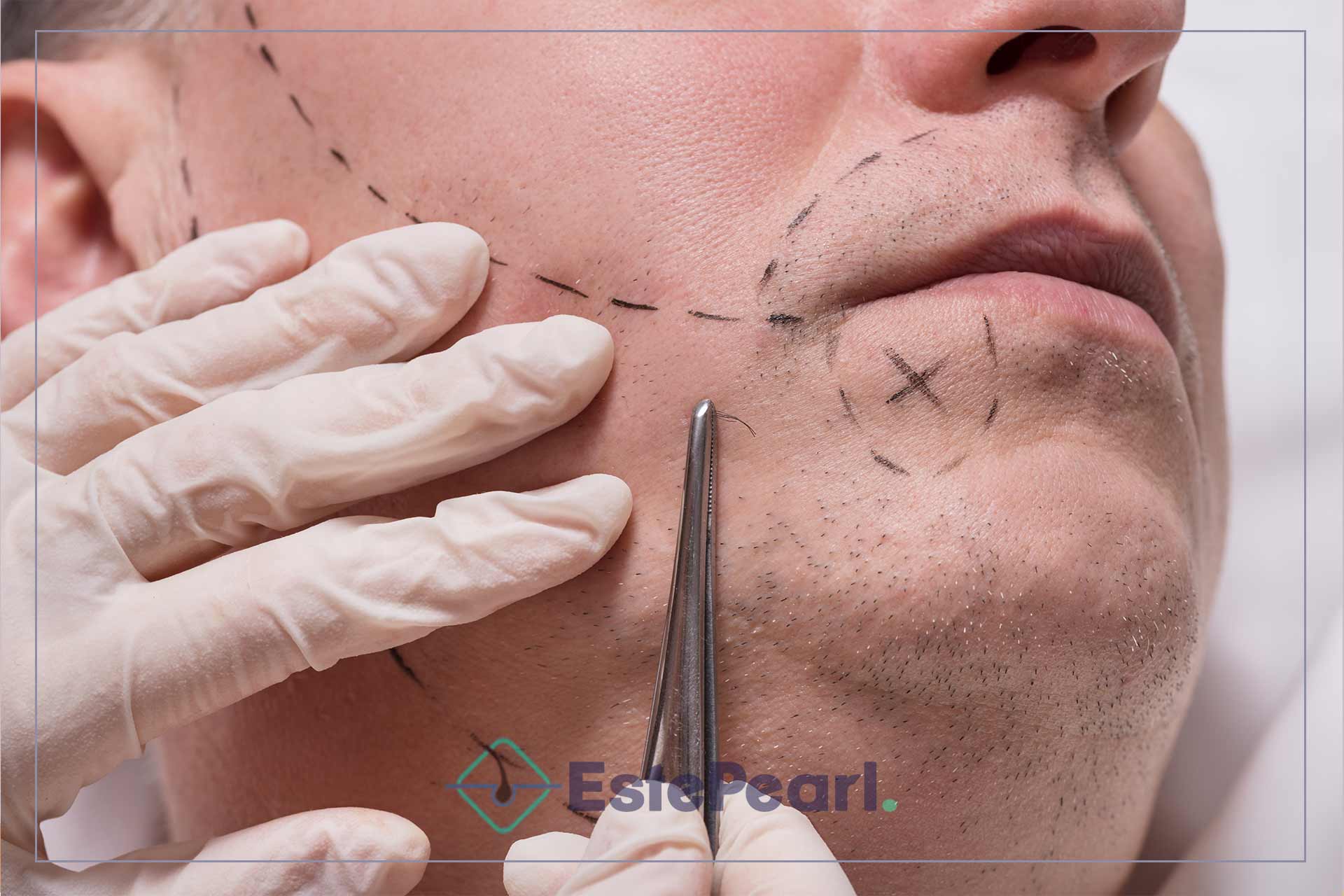 How Is Beard Transplantation Done Using DHI Method