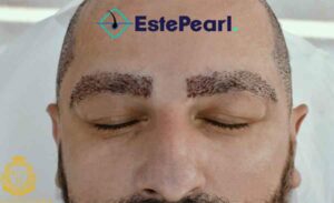 Eyebrow Hair Loss