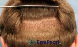 How Do You Treat Diffuse Hair Loss In The Donor Area