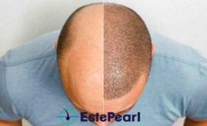 Success Rate of Hair Transplantation