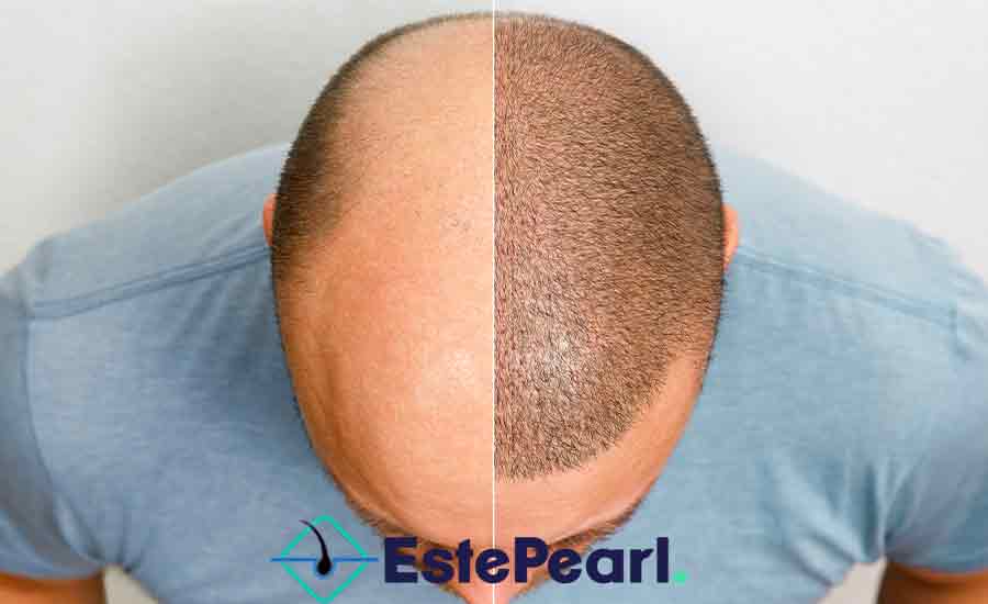Success Rate of Hair Transplantation