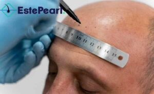 Which Season Is The Best For Hair Transplant