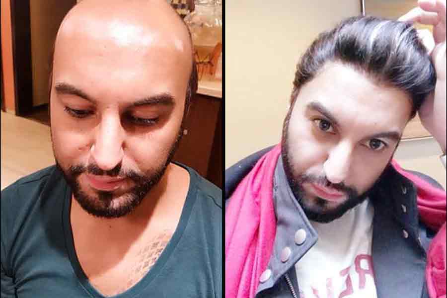 Hair replacement