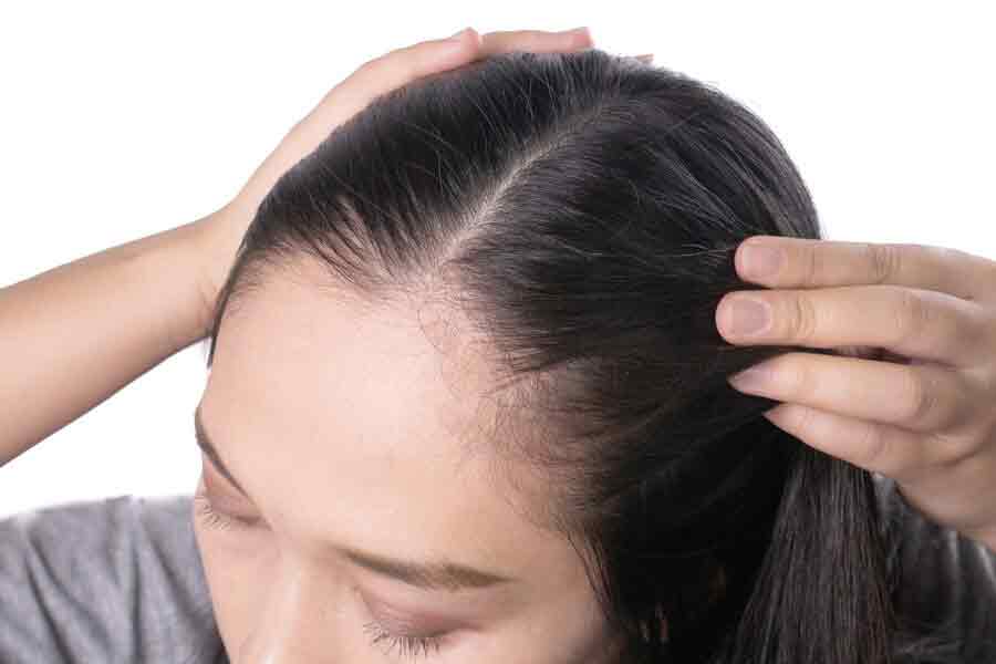 Thinning Hair